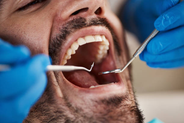 Emergency Dental Filling Replacement in OH